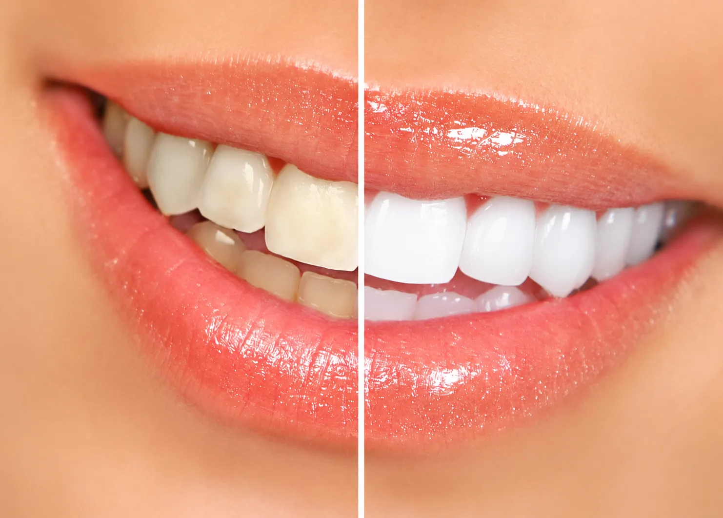 Professional teeth whitening at Vasantha Dental Clinic Visakhapatnam